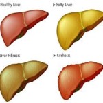 Fatty Liver